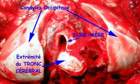 la pi&egrave;ce d'autopsie avant pr&eacute;l&egrave;vement
